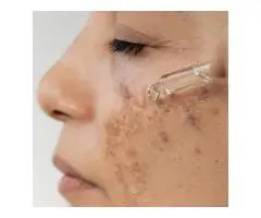 Hyperpigmentation Treatment Tampa for Radiant Skin