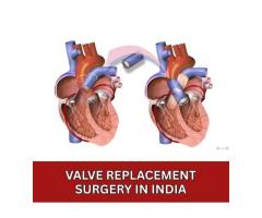 Cost of Valve Replacement Surgery India
