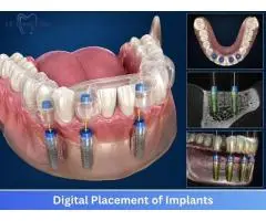 Digital Placement of Implants in Mumbai AK Dental Clinic