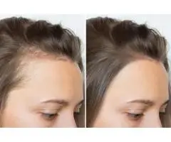 Hairline Tattoo A Subtle Approach to a Fuller, More Defined Hairline