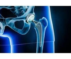 Hip Replacement Surgery in Delhi | Dr. Rajesh Malhotra